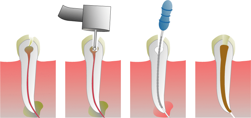 Dental Root Canal- Essential Things You Need to Know