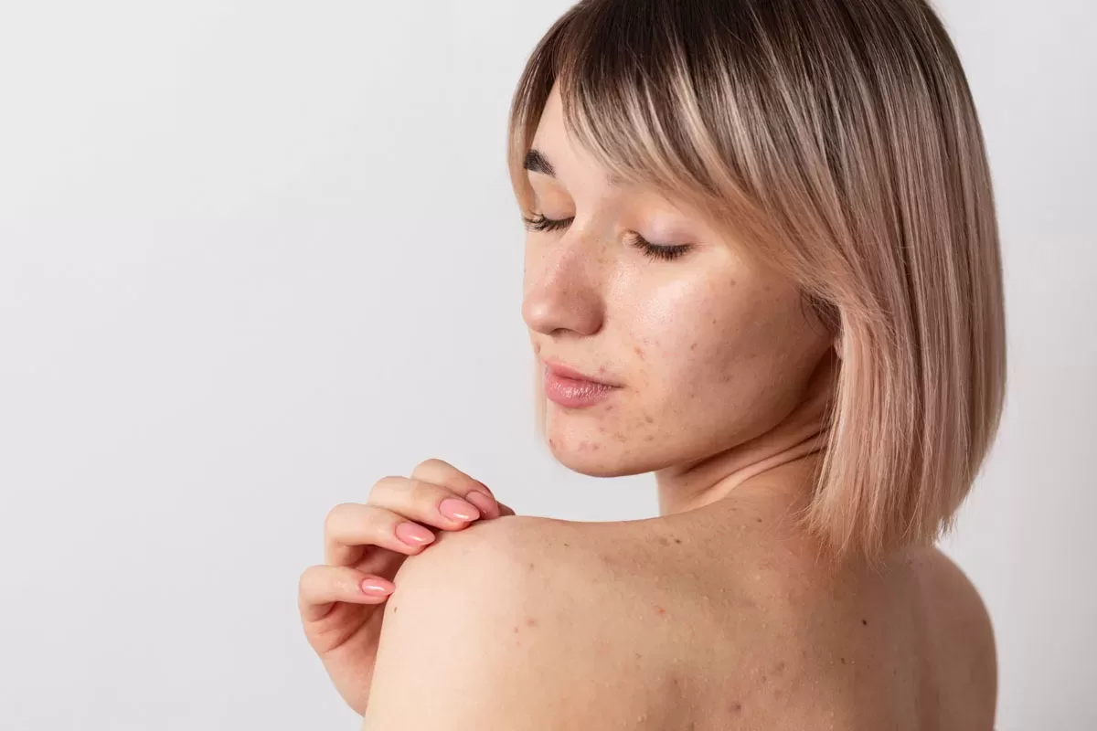 Back Acne